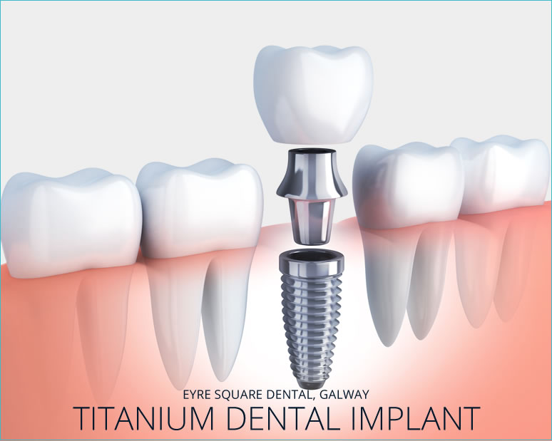 Titanium Dental Implant